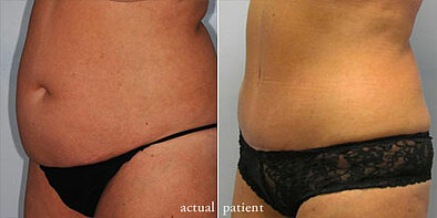 Mommy Makeover: Tummy Tuck - Regain Your Pre-Baby Figure