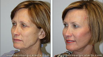 Facelift Misconceptions & Deep Plane Facelift for Natural Look