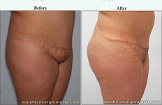 Mons Pubis Lift (Reverse Abdominoplasty) Debulking with