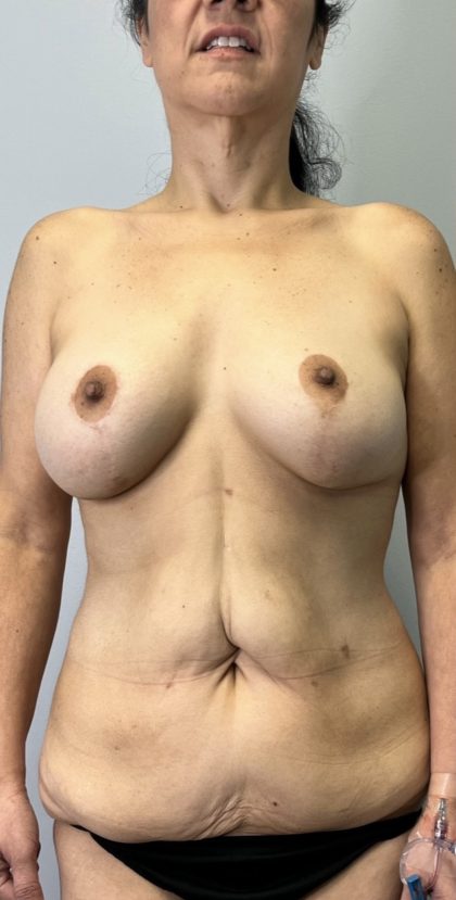 Corrective Breast Procedures Before & After Patient #6025