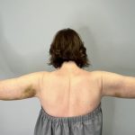 Arm Lift (Scarless Arm Lift) Before & After Patient #5951