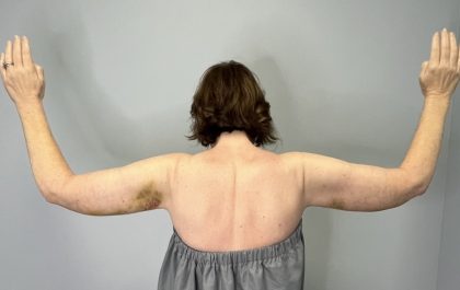 Arm Lift (Scarless Arm Lift) Before & After Patient #5951