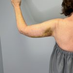 Arm Lift (Scarless Arm Lift) Before & After Patient #5951