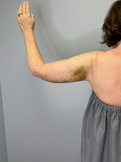 Arm Lift (Scarless Arm Lift) Before & After Patient #5951