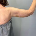 Arm Lift (Scarless Arm Lift) Before & After Patient #5951