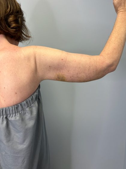 Arm Lift (Scarless Arm Lift) Before & After Patient #5951