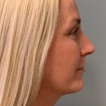 Blepharoplasty Before & After Patient #6035