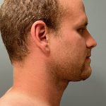 Deep Plane Neck Lift Before & After Patient #6105