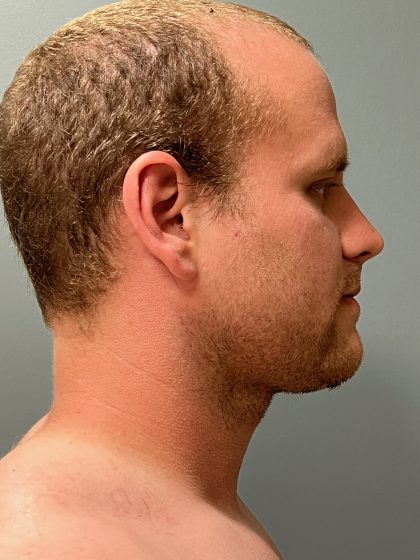 Deep Plane Neck Lift Before & After Patient #6105