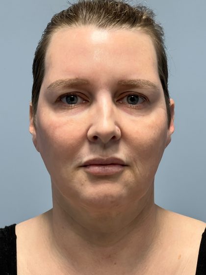 Deep Plane Facelift Before & After Patient #6042