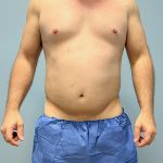 Hi Def Liposuction Before & After Patient #5963