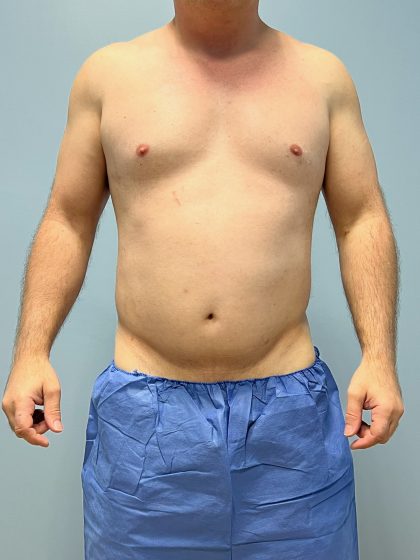 Hi Def Liposuction Before & After Patient #5963