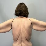 Arm Lift (Scarless Arm Lift) Before & After Patient #5951