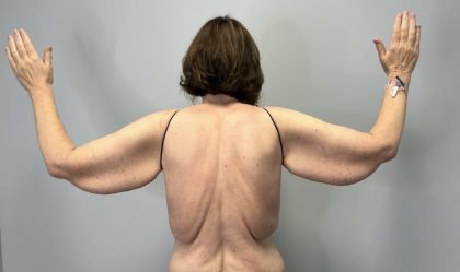 Arm Lift (Scarless Arm Lift) Before & After Patient #5951