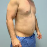 Hi Def Liposuction Before & After Patient #5963