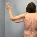 Arm Lift (Scarless Arm Lift) Before & After Patient #5951