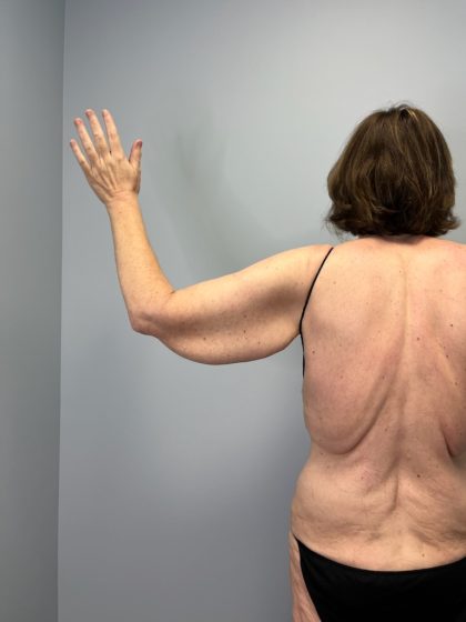 Arm Lift (Scarless Arm Lift) Before & After Patient #5951