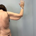 Arm Lift (Scarless Arm Lift) Before & After Patient #5951