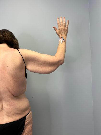 Arm Lift (Scarless Arm Lift) Before & After Patient #5951