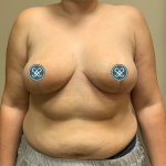 Breast Reduction Before & After Patient #6032