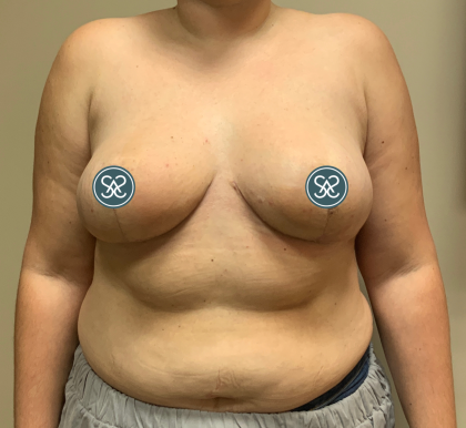 Breast Reduction Before & After Patient #6032