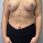 Breast Augmentation Before & After Patient #6020