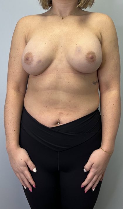 Breast Augmentation Before & After Patient #6020