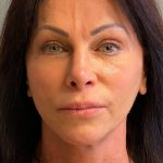 Deep Plane Facelift Before & After Patient #6049