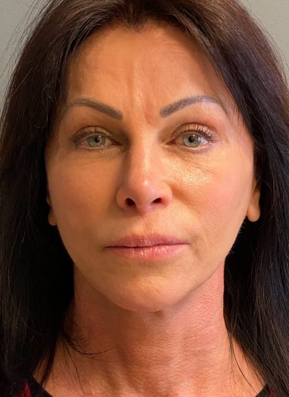 Deep Plane Facelift Before & After Patient #6049