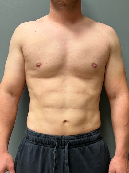 Hi Def Liposuction Before & After Patient #5970