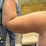 Arm Lift (Scarless Arm Lift) Before & After Patient #5958