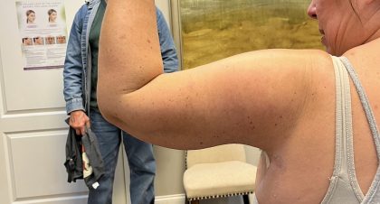 Arm Lift (Scarless Arm Lift) Before & After Patient #5958