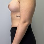 Breast Augmentation Before & After Patient #6020