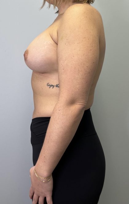 Breast Augmentation Before & After Patient #6020