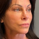 Deep Plane Facelift Before & After Patient #6049