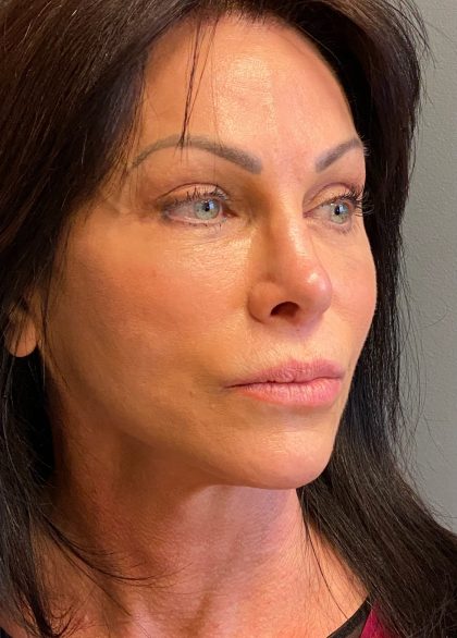 Deep Plane Facelift Before & After Patient #6049