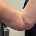 Arm Lift (Scarless Arm Lift) Before & After Patient #5958