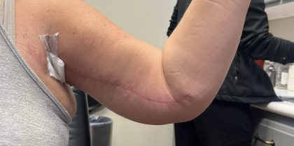 Arm Lift (Scarless Arm Lift) Before & After Patient #5958