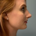 Rhinoplasty Before & After Patient #6133