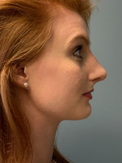 Rhinoplasty Before & After Patient #6133