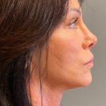 Deep Plane Facelift Before & After Patient #6049