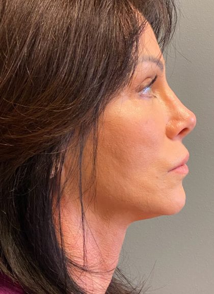 Deep Plane Facelift Before & After Patient #6049