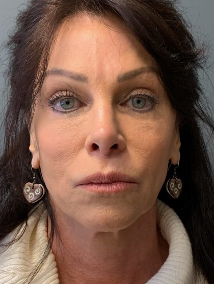 Deep Plane Facelift Before & After Patient #6049