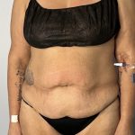 Liposuction Before & After Patient #6001