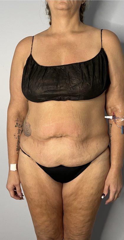 Liposuction Before & After Patient #6001