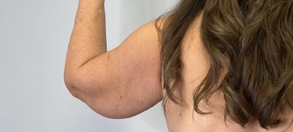 Arm Lift (Scarless Arm Lift) Before & After Patient #5958