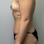 Breast Augmentation Before & After Patient #6020