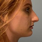 Rhinoplasty Before & After Patient #6133