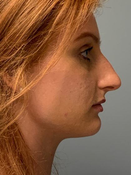 Rhinoplasty Before & After Patient #6133