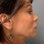 Deep Plane Facelift Before & After Patient #6049